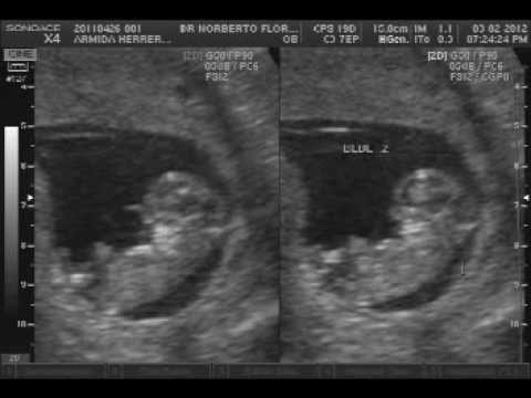 Imagenes de ultrasonidos de gemelos de 4 meses - Imagui Imagenes de ultrasonidos de gemelos de 4 meses - Imagui
