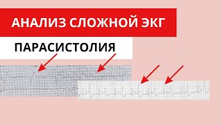 Парасистолия Или Желудочковые Экстрасистолы? Анализ Сложной Экг.