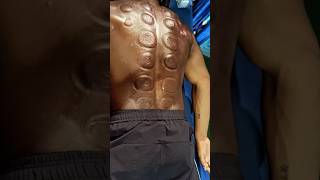 Cupping therapy for recovery