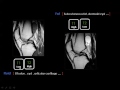 Imaging of Knee joint part 1   Prof Dr  Mamdouh Mahfouz In Arabic