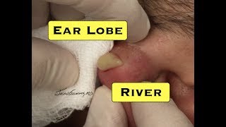 Giant Pus Filled Earlobe Redux With Comments Giant Pus Filled Earlobe Redux With Comments