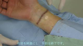 刺青切除(1回切除) 山本クリニック
