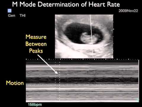 Intrauterine Pregnancy - Part 2 - SonoSite, Inc. - YouTube