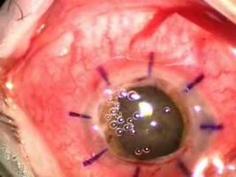 Tags:NHS Choices health corneal transplant procedure eye