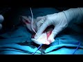 adult circumcision