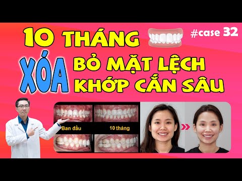 "Thổi Bay" Mặt Lệch Và Hàm Bạnh Chỉ Sau 10 Tháng Với Vinalign