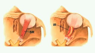 Clinical Anatomy Of The Oculomotor Cniii, Trochlear Cniv, And Abducens Cnvi Nerves Subled