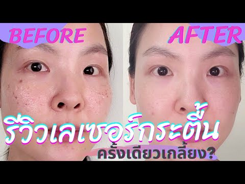รีวิวเลเซอร์กระตื้นทุกขั้นตอน หน้าบางไหม? กระจะขึ้นอีกไหม?