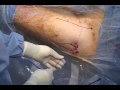 Portal Placement in Hip Arthroscopy