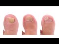 Toenail Fungus Treatment - A Fast Cure For Toenail Fungus You Need to Try Immediately!