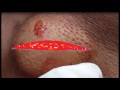 Sebaceous Cyst On Back