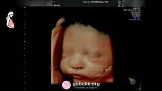 37 haftalık (9 aylık) bebeğin 4 boyutlu HD net ultrason görüntüleri. - Dr. Kağan Kocatepe