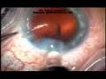 Intraocular Lens Types Of Piols | RM. Intraocular Lens Types Of Piols | RM.