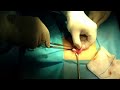 Appendectomy is perhaps the commonest gastrointestinal surgery in general surgical practice