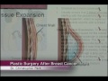 Breast Reconstruction with Dr. Christopher Park, Mobile Alabama