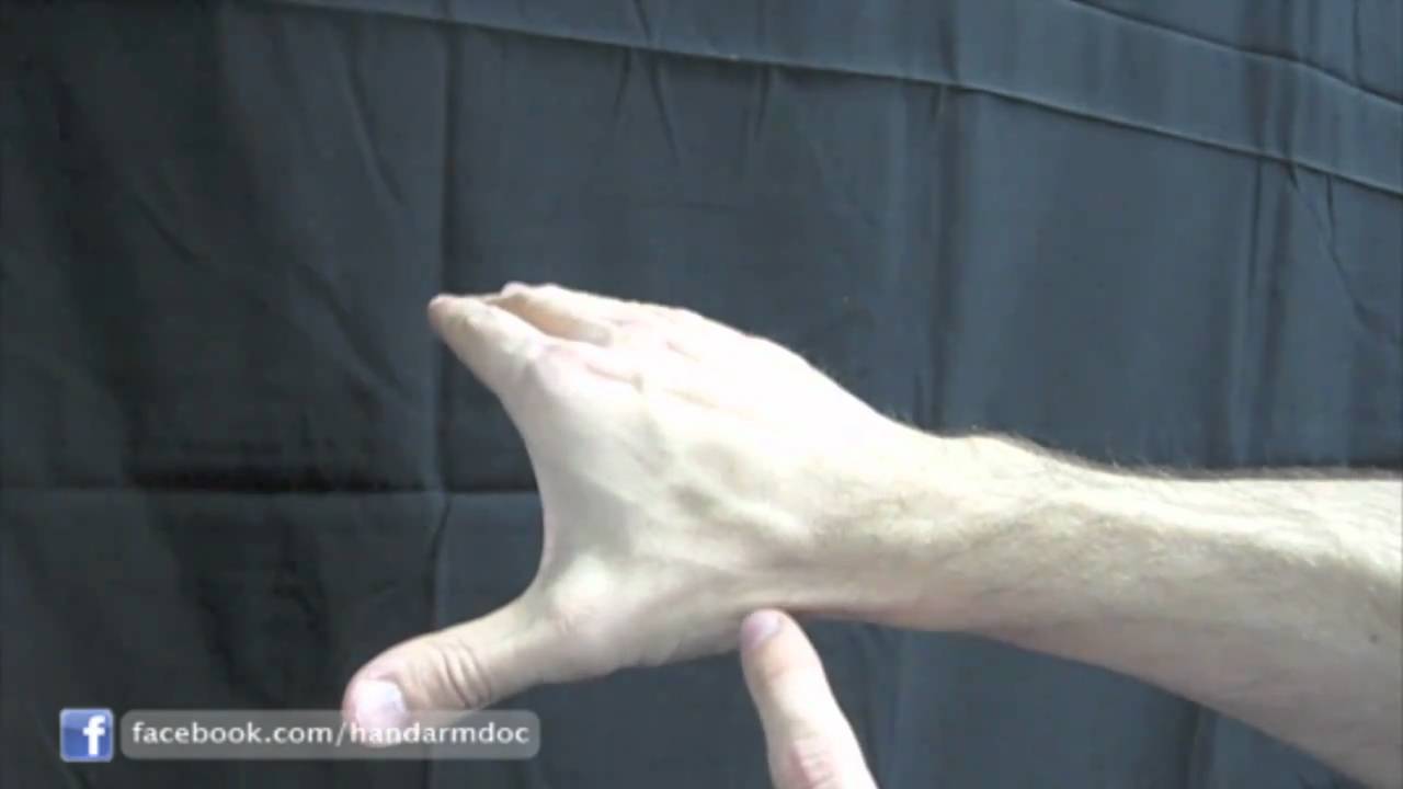 Mommy Thumb - A Common Cause of Wrist and Hand Pain - YouTube
