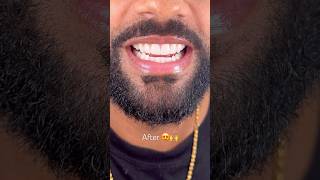 Before Vs After Invisalign And Composite By Dr. Josh