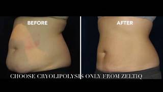 Coolsculpting By Zeltiq