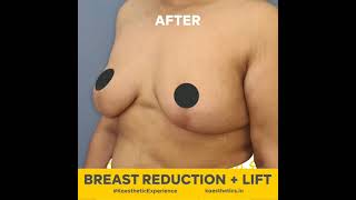 Before And After Results Of Breast Reduction With Lift To The Breasts