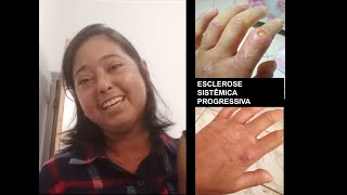 Liliane - Esclerose Sistêmica Progressiva