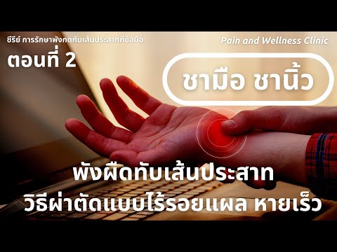 พังผืดกดทับเส้นประสาทที่ข้อมือ วิธีผ่าตัดแบบไร้รอยแผล หายไว