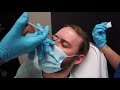 Male Botox - "Brotox" - With Dr. Rebowe at The Park Clinic