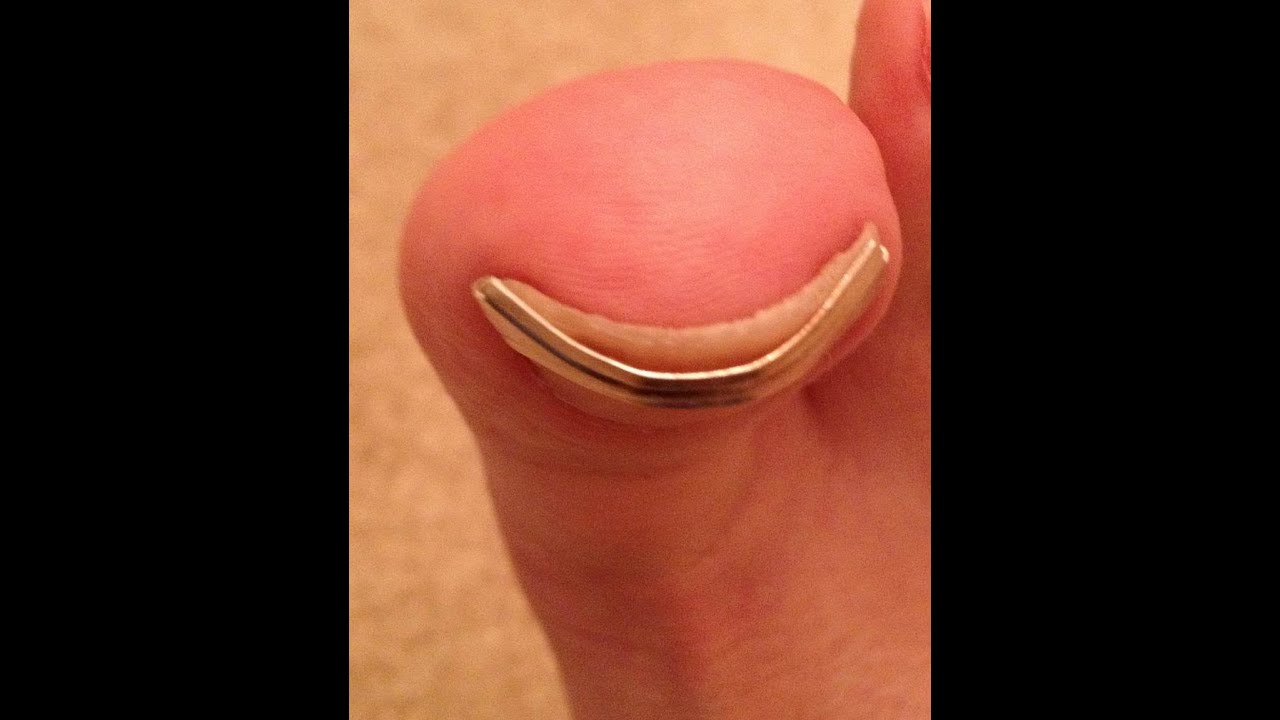 Toenail Straightening Spring Clip for Curved or Ingrown Toenails - YouTube