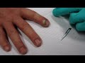 I & D of Acute Paronychia (incision and drainage)