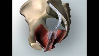 Sacrocolpopexy. Animated Video About Pelvic Prolaps Surgery