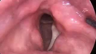 Vocal Cord Paralysis Before Surgery - .Wohlt
