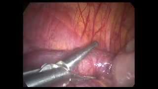 Art Of Endoscopy With Osama Shawki,Bicornuate Uterus, Long Tube