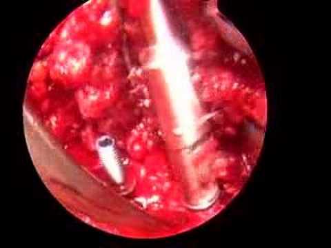 Laminectomy And Discectomy. A lumbar laminectomy, or