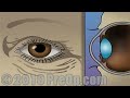 PreOp® Patient Education Small Incision Cataract Surgery