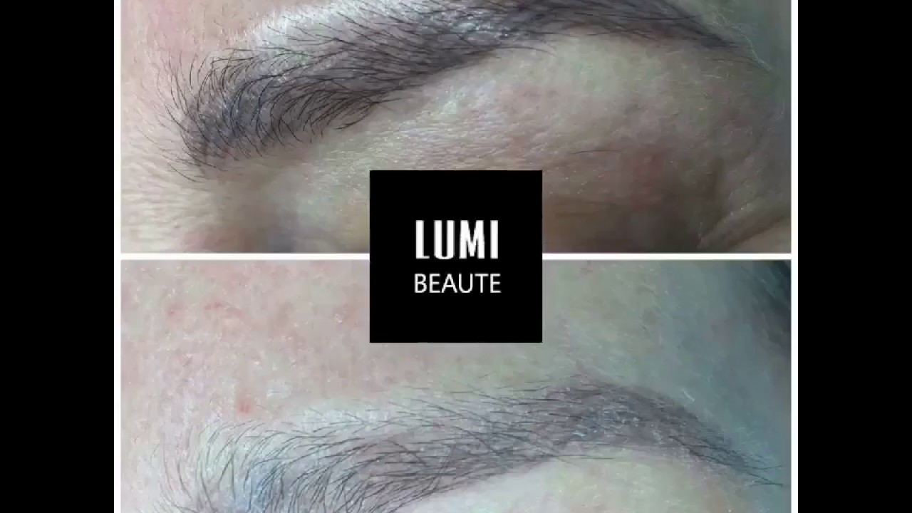 Détatouage