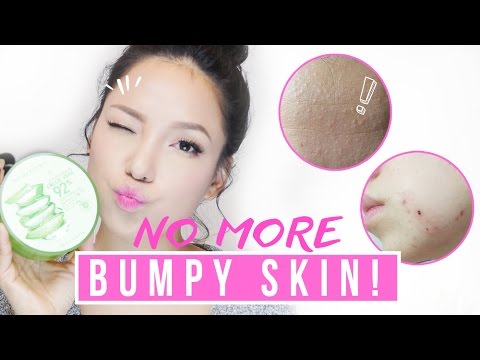 Get rid of Tiny Bumps & Pimples in ONE WEEK (it works!!) - YouTube