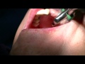 Physics Forceps - Full Upper Tooth Extractions