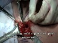 hernioplastia