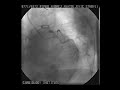Video Coronography, after heart attack, 2 blockages.