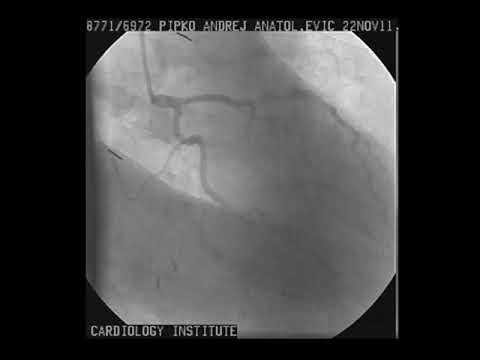 Coronography, after heart attack, 2 blockages.