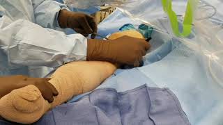Surgical Treatment Of Insufficiency Fractures Of The Knee