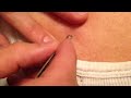 zit