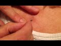 zit