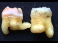 Morfología pulpar Tercer molar inferior
