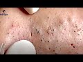 Super Blackheads Part 2 | Ga Spa| 07.02.2022