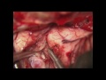 MCA fusiform aneurysm clipping that required EC-IC Bypass by Jon White, MD