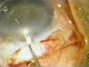 Small Incision Sutureless Cataract Surgery (SICS)