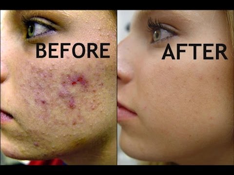 for Masks Face Homemade acne  mask diy DIY YouTube   face Acne