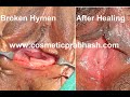 Virginity Tightening Hymen Repair Layered Hymenoplasty Surgery Delhi NCR India.