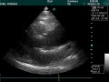 ascending aortic aneurysm doppler ultrasound echocardiography