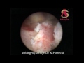 endometrium